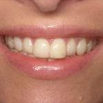 Veneers before