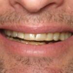Full Mouth Reconstruction Before