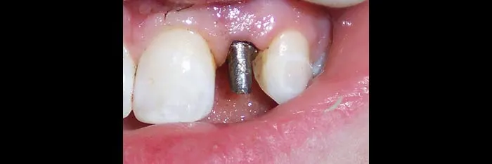 Implant Post