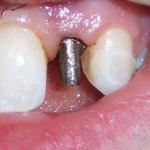 Implant Post