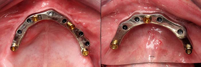 Upper and Lower Tissue Bars