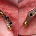 Upper and Lower Tissue Bars