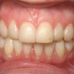 Veneers before