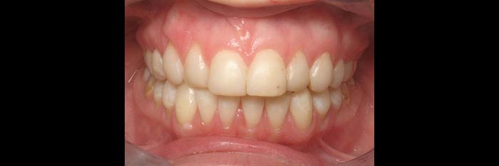 Veneers before