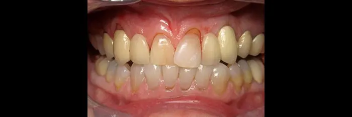 Bridges Before