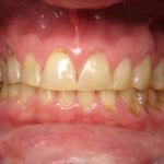 Full Mouth Reconstruction Before