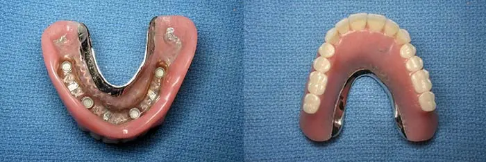 Upper Denture