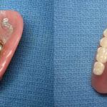 Upper Denture