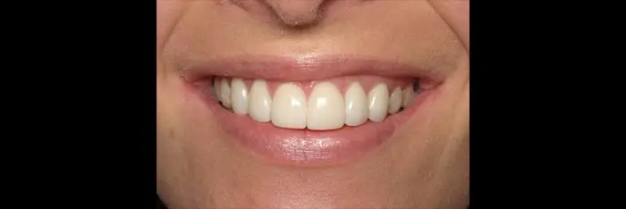 Veneers after