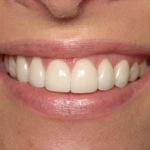 Veneers after