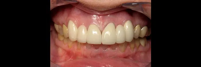 Bridges After