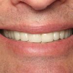 Full Mouth Reconstruction After
