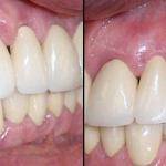 Attachments to Retain Partial