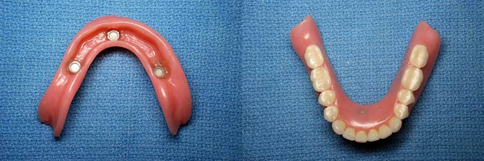Lower Denture