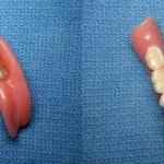 Lower Denture