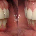 Veneers after