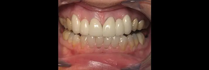 Bridges After