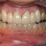 Bridges After