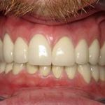 Full Mouth Reconstruction After
