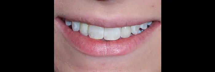 After Implants