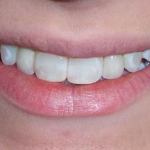 After Implants