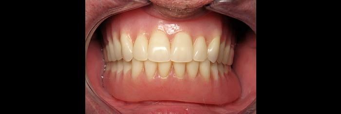 Dentures in Place