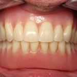 Dentures in Place