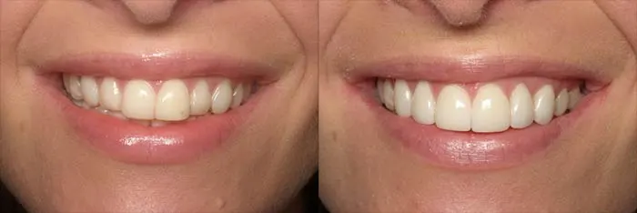 Veneers Before and After