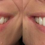 Veneers Before and After