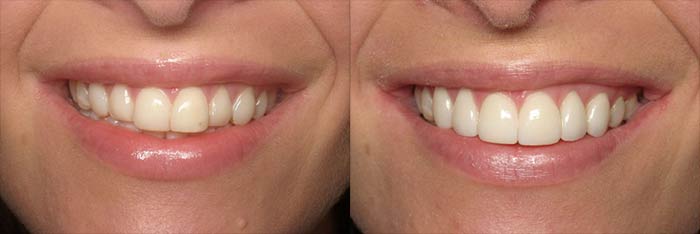 Veneers Before and After