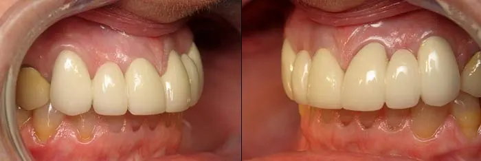 Bridges After