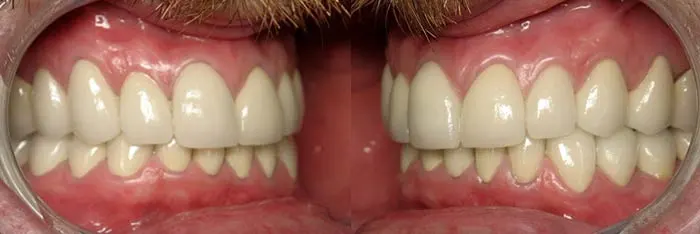 Full Mouth Reconstruction After