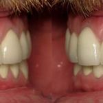 Full Mouth Reconstruction After