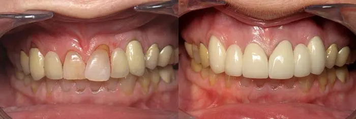 Bridges Before and After