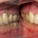 Bridges Before and After