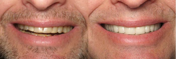 Full Mouth Reconstruction Before and After