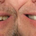 Full Mouth Reconstruction Before and After