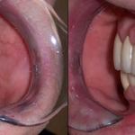 Crowns with Partial in Place