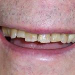 Veneers before
