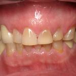 Full Mouth Reconstruction Before