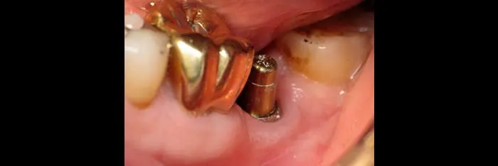 Implant Post