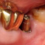 Implant Post