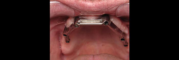 Upper Tissue Bar