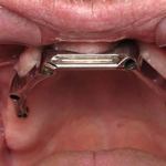 Upper Tissue Bar