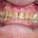 Veneers before