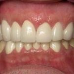 Full Mouth Reconstruction After