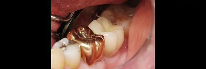 Implant Crown
