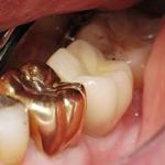 Implant Crown