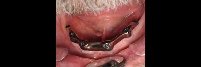 Lower Tissue Bar