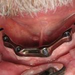 Lower Tissue Bar